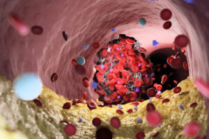 Profilaktyka miażdżycy